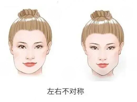 下頜骨一高一低臉歪怎么矯正？左右臉不對稱能矯正過來嗎？