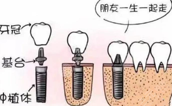 上海仁濟(jì)醫(yī)院牙齒種植案例