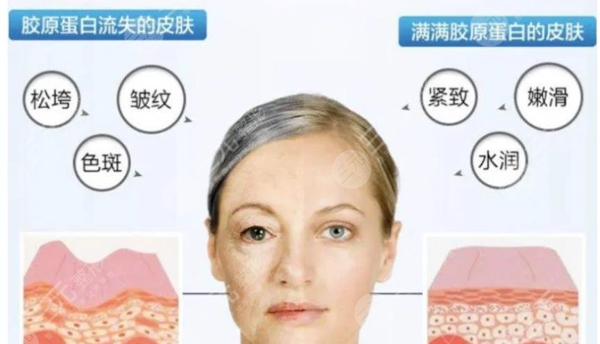 膠原蛋白注射一針多少錢?