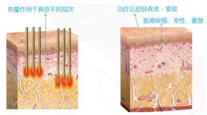 熱瑪吉的能量大小對(duì)效果有沒有影響