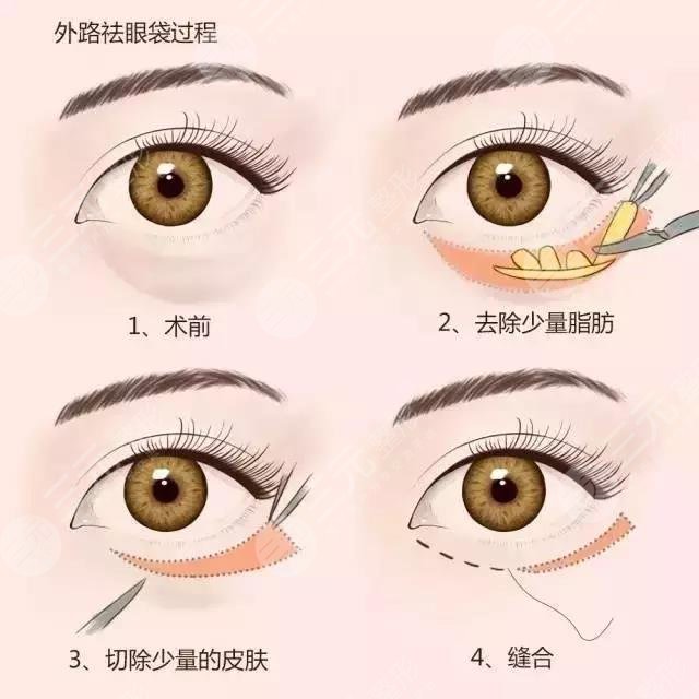 天津長征醫(yī)?院去眼袋怎么樣?