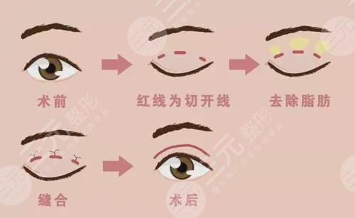 天津長征醫(yī)?院去眼袋怎么樣?