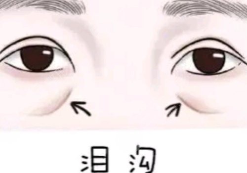 淚溝凹陷怎么解決好？