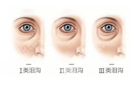 淚溝填充大概要多少錢(qián)？