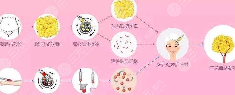 自體脂肪