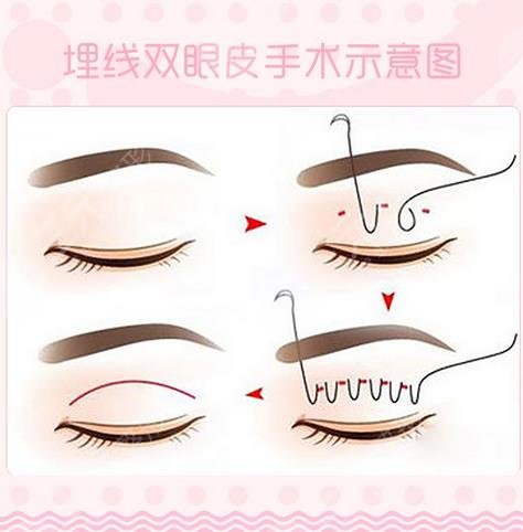佀同帥雙眼皮修復野生案例