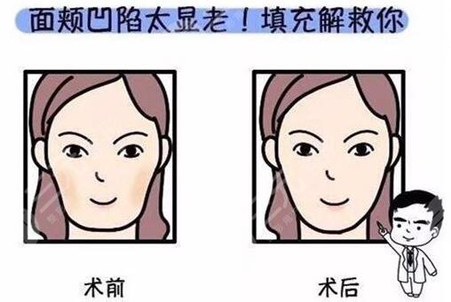 填充面部整形要多少錢？價格表匯總！3種常用材料對比，必看~