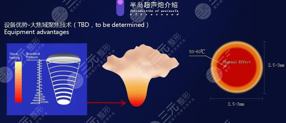 半島超聲炮黃金版價(jià)格是多少