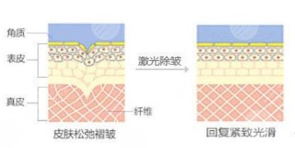 激光