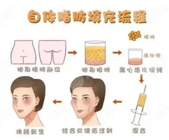 北京美萊整形醫(yī)院脂肪填充多少錢