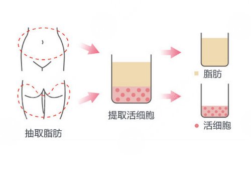 額頭填充有風險嗎