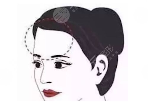 額頭填充有風險嗎
