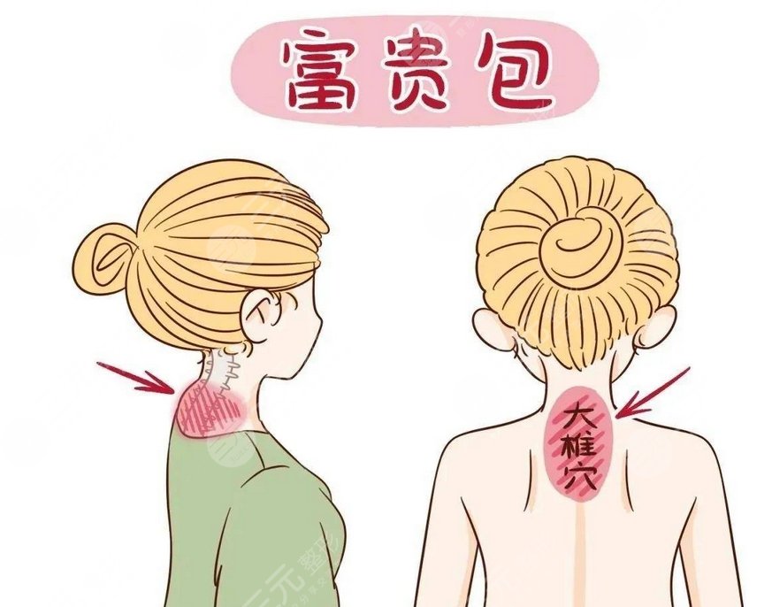 上海九院做富貴包怎么樣