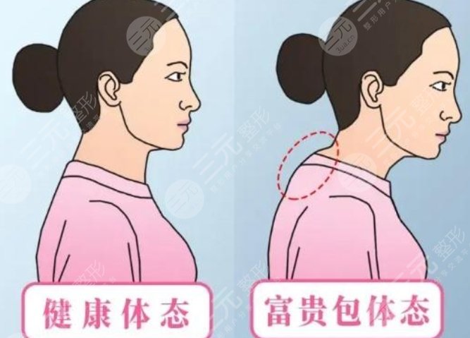 上海九院整復外科做富貴包案例