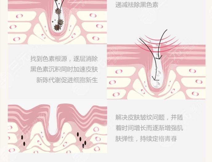 上海華山醫(yī)院?點陣激光祛痘坑效果怎么樣?