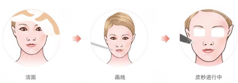 皮秒激光