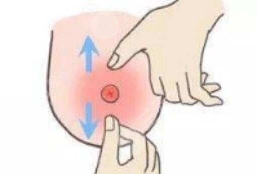 乳暈