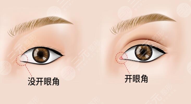 陸軍總醫(yī)院美容中心開眼角科普知識分享