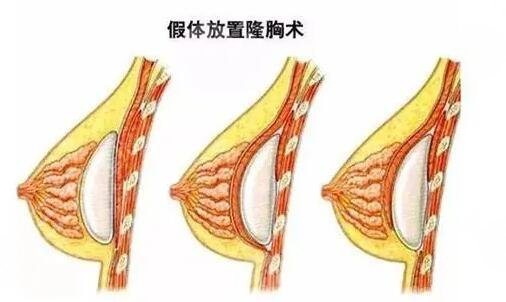 韓國蓓拉假體的價格貴嗎？