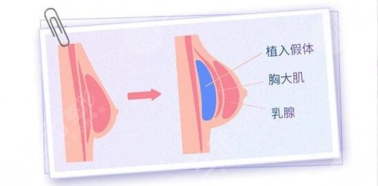韓國蓓拉假體的注意事項(xiàng)有哪些？
