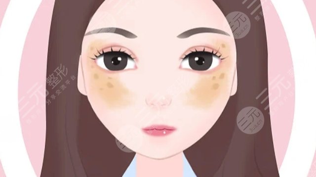蝴蝶斑
