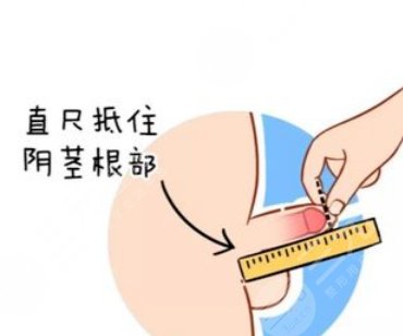 陰莖延長(zhǎng)術(shù)