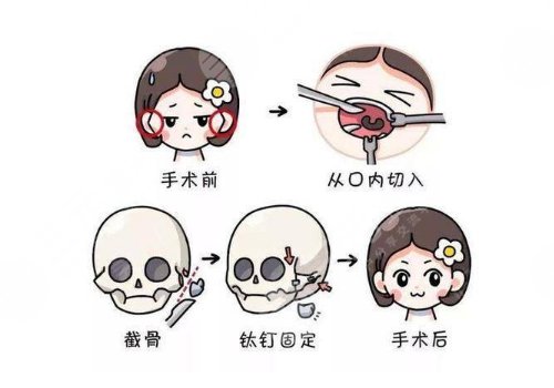 下頜骨整容整形的方法