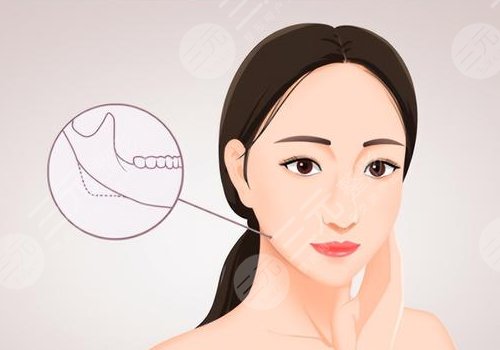 下頜手術(shù)大概需要多少錢