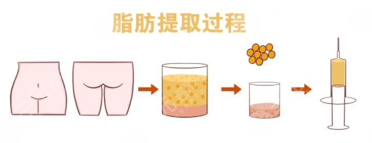 全臉脂肪填充