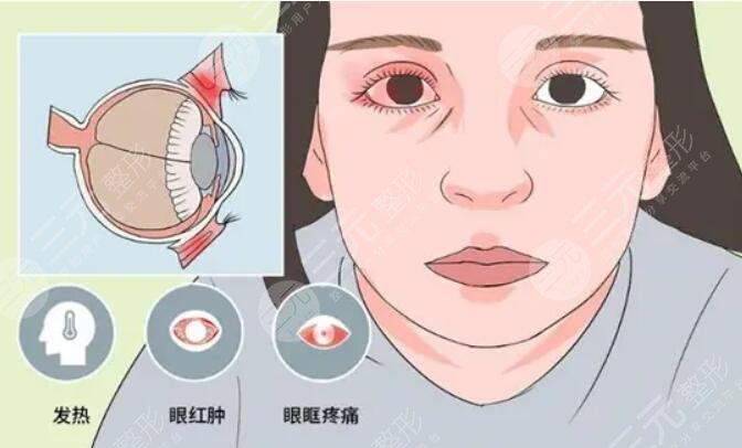 眼底水腫