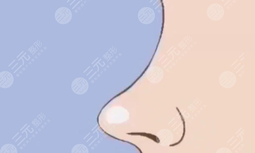 肋骨鼻.jpg