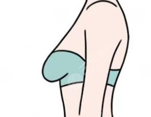 乳房下垂矯正