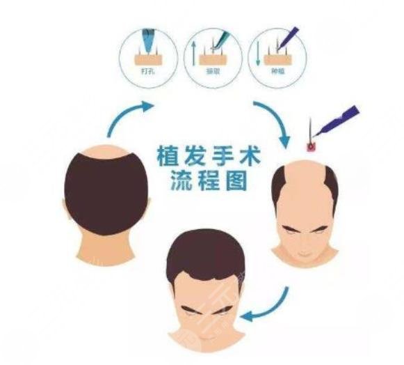 上海國際醫(yī)學(xué)中心植發(fā)案例