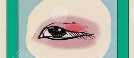 雙眼皮
