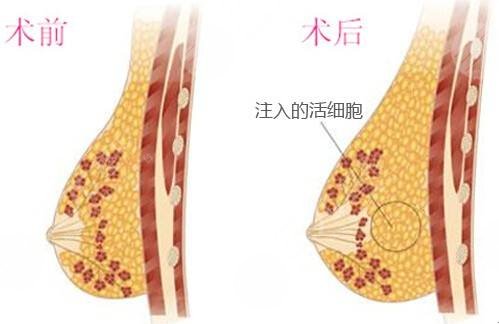 隆胸