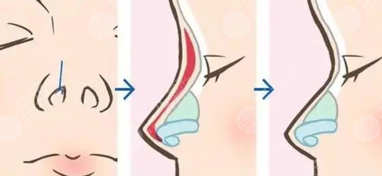 深圳劉博隆鼻案例