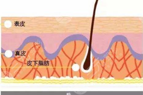 激光嫩膚