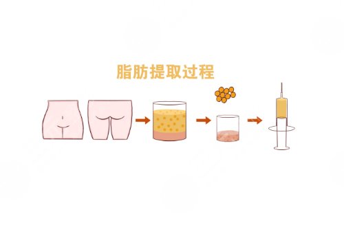 自體脂肪豐胸手術(shù)費大概要多少錢