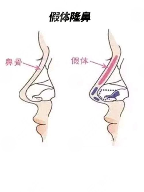 廣州梁進(jìn)華醫(yī)生假體隆鼻案例分享