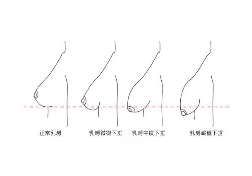 李天石醫(yī)生隆胸多少錢