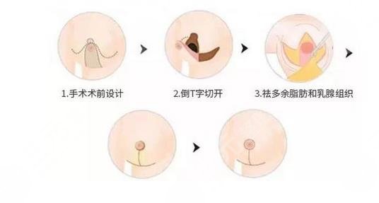 縮胸手術(shù)風(fēng)險(xiǎn)大嗎?會危及生命嗎?