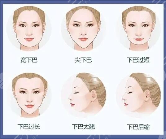 深圳填充下巴多少錢？玻尿酸2800元起，輪廓塑形指南！