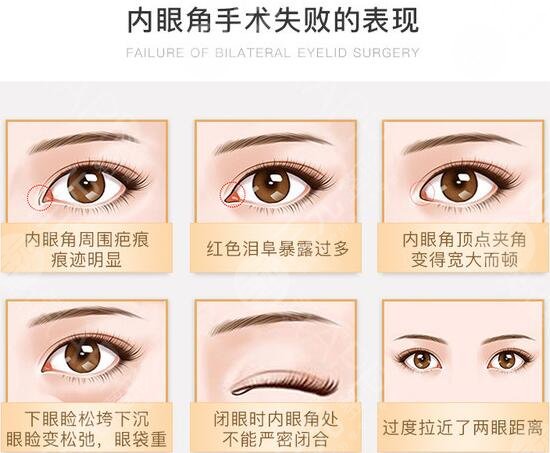 合肥李小靜眼角回包修復(fù)案例分享！安醫(yī)熱門整形醫(yī)生，等你品評(píng)~