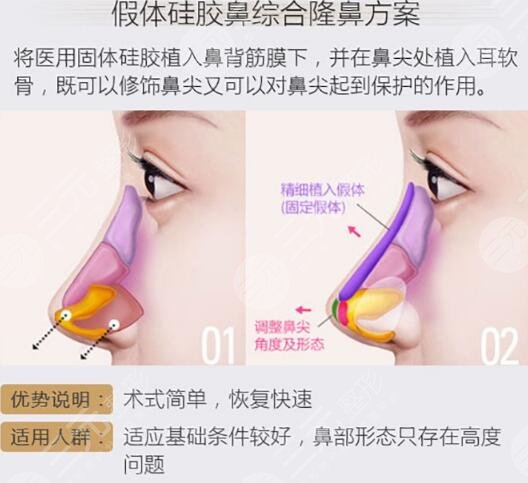 張明興個(gè)人資料及圖片案例分享，廣州華美熱門醫(yī)生，隆鼻好評(píng)多！