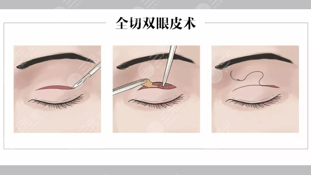 合肥李小靜雙眼皮案例分享！安醫(yī)附院整形實(shí)力派，醫(yī)生風(fēng)格揭秘~