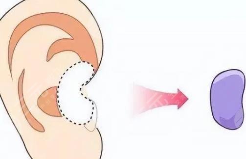 耳軟骨隆鼻