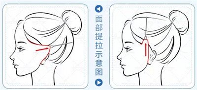 拉皮
