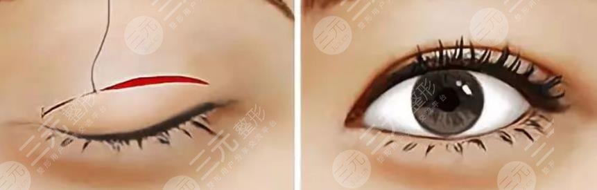 雙眼皮
