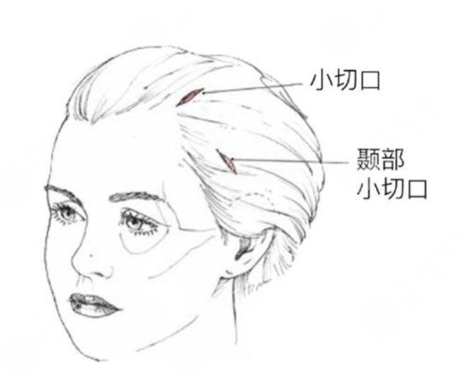 拉皮手術