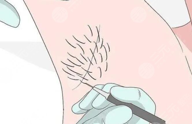 脫腋毛